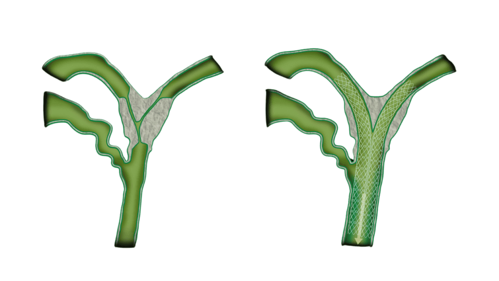 Stent-by-Stent (SBS)