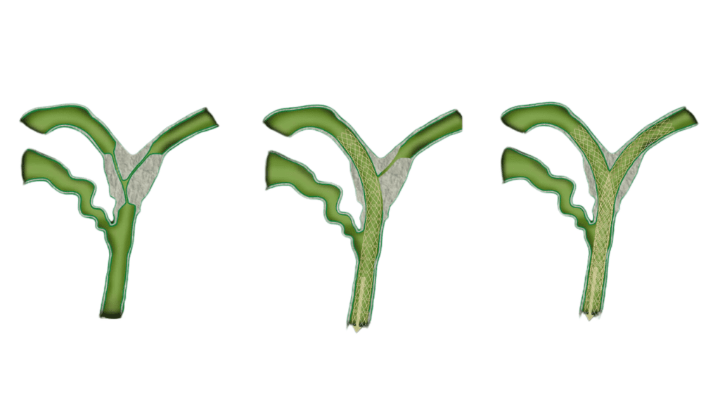 Stent-in-Stent (SIS)