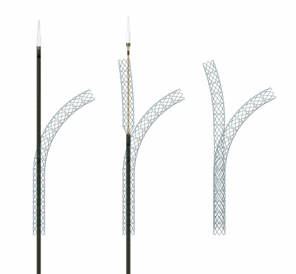 stent deployment three step composite